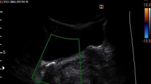 Камень мочеточника на УЗИ почек и мочевого пузыря