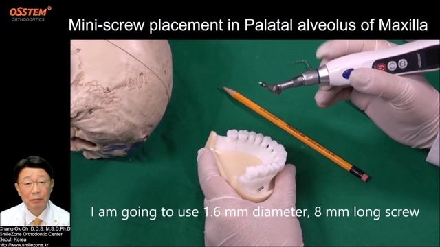 Ортодонтический винт 5  Альвеолярный гребень верхней ?