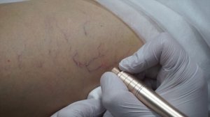 Удаление Общирной Сосудистой Сетки На Ноге
