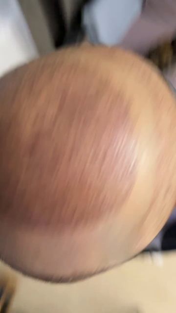 2 день после пересадки волос смотреть онлайн