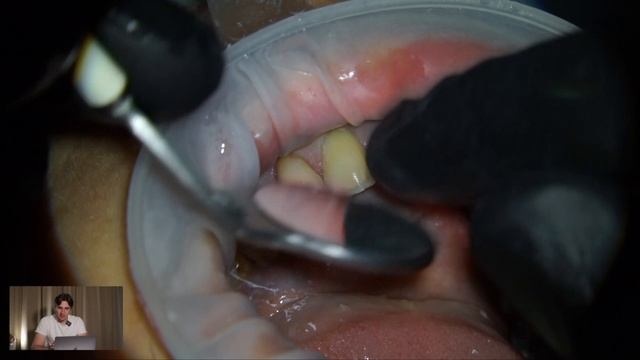 СТОМБУДНИ#51 Препарирование зубов под виниры и керамические накладки смотреть онлайн