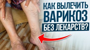 ИЗБАВЬСЯ от ВАРИКОЗА раз и НАВСЕГДА! / Первопричины и метод борьбы с расширением вен