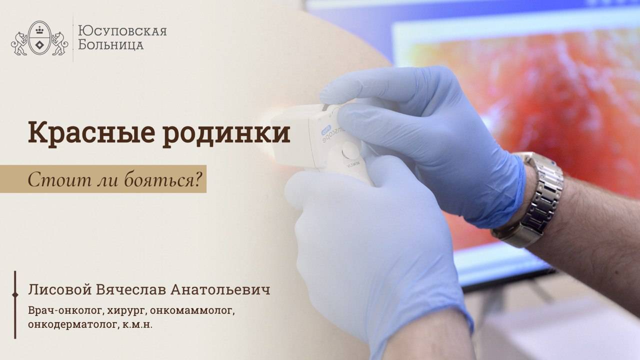 Родинки: какие опасны? Обследование в Юсуповской Больнице смотреть онлайн