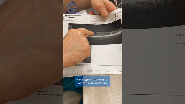 Cамоизлечение макулярного разрыва. Офтальмология. смотреть онлайн