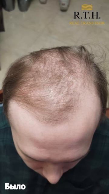 Как изменилась прическа через 6 месяцев после пересадки волос? смотреть онлайн
