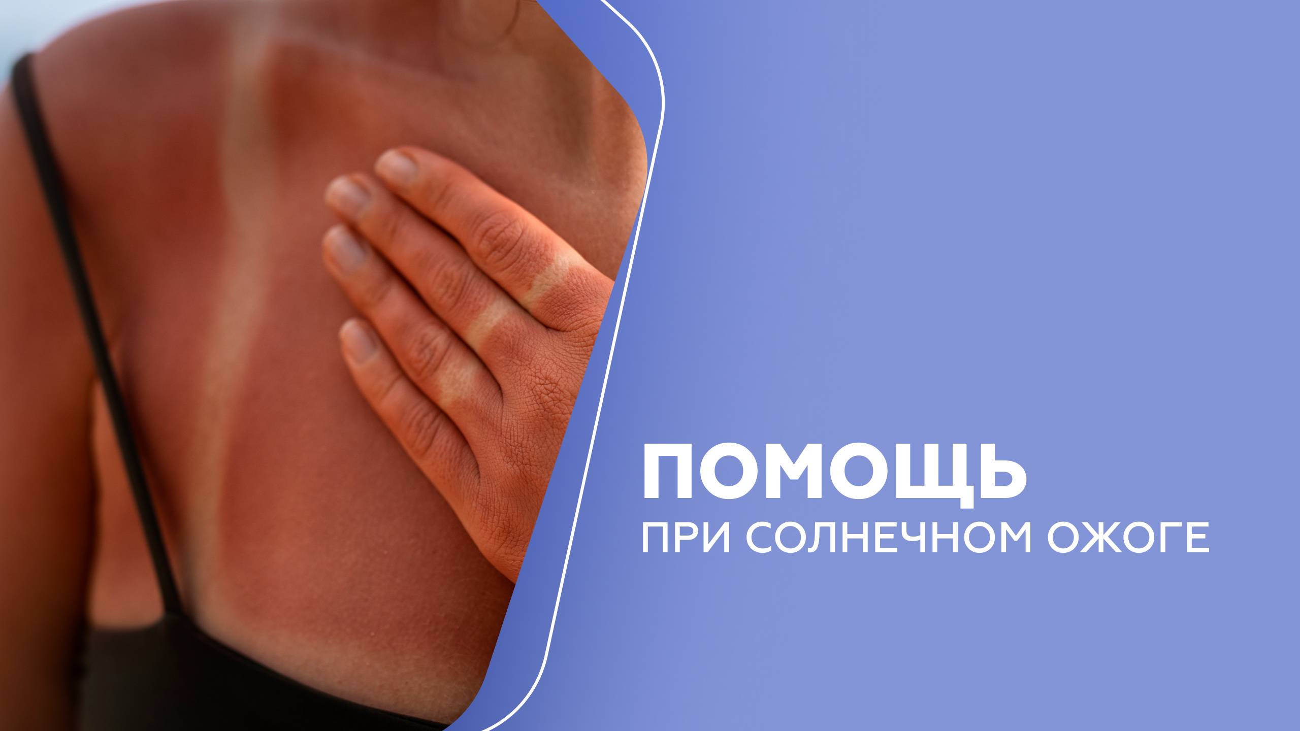 Что делать, если вы всё-таки сгорели? смотреть онлайн