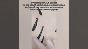Постановка пиявок на печень