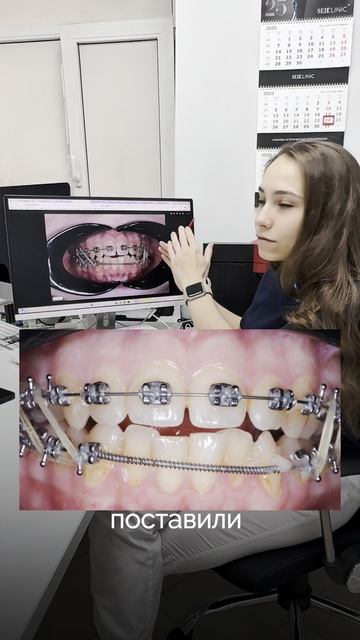 Разбор кейса лечения на брекет-системе