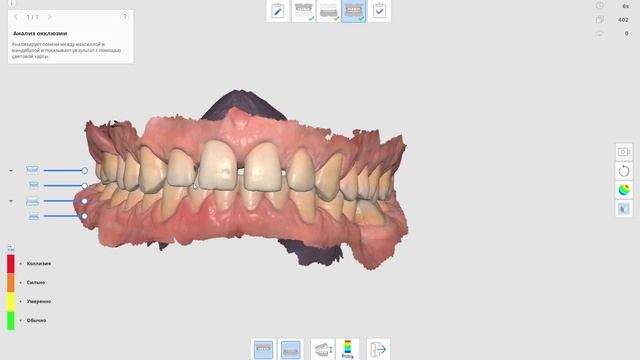 Сканирование зубов 2