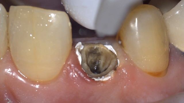 История одного зуба