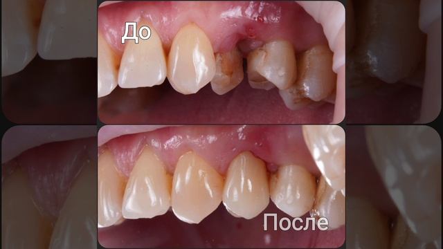 Что такое фрактура - почему это происходит ?