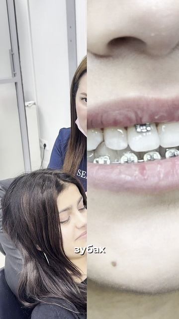 Лечение кариса при ношении брекетов