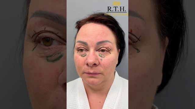 Блефаропластика. До и после! смотреть онлайн