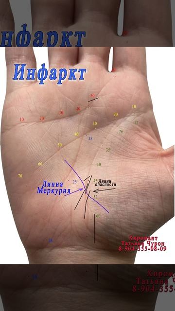 Инфаркт. Опасные знаки на ладони. Хиромантия.