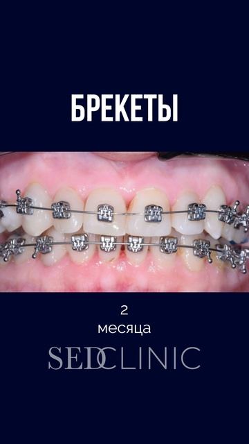 Как брекеты меняют улыбку