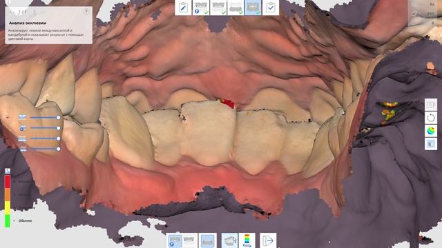 Сканирование зубов