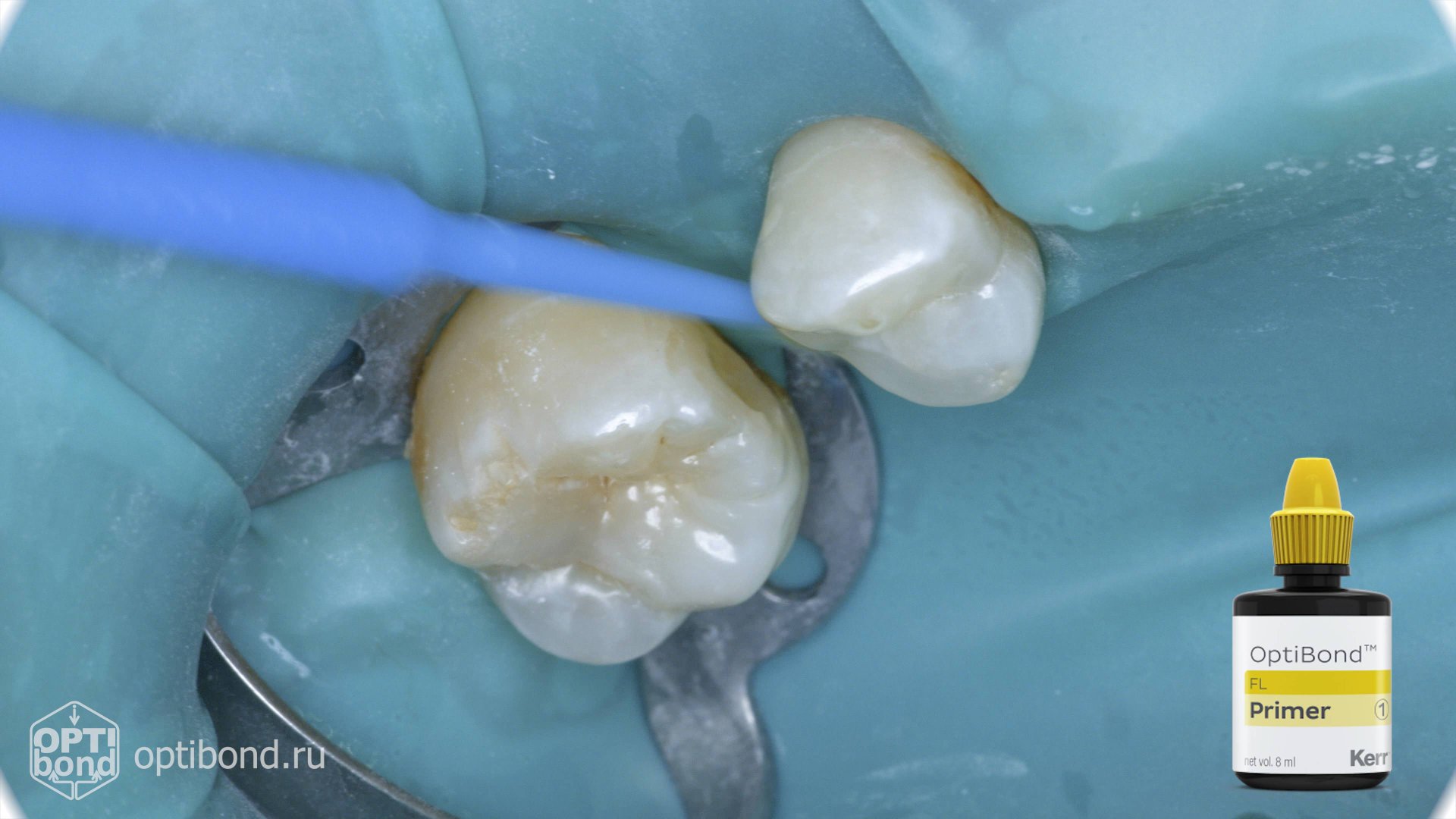 #Optibond Application To Occlusial Surfaces Of Tooth  14, 16 #rubberdamology