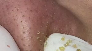 Извлечение угрей и камедонов - очень залипательно и раслабляет