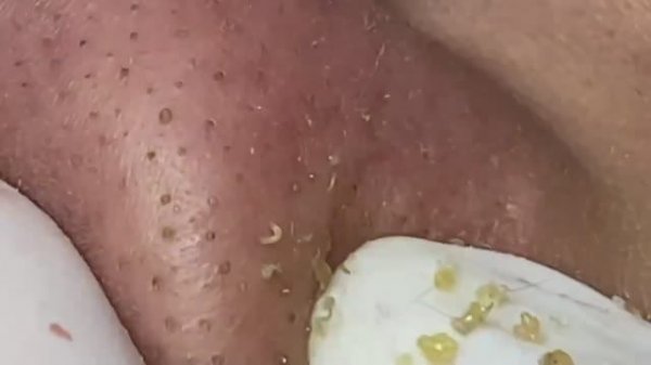 Извлечение угрей и камедонов - очень залипательно и раслабляет