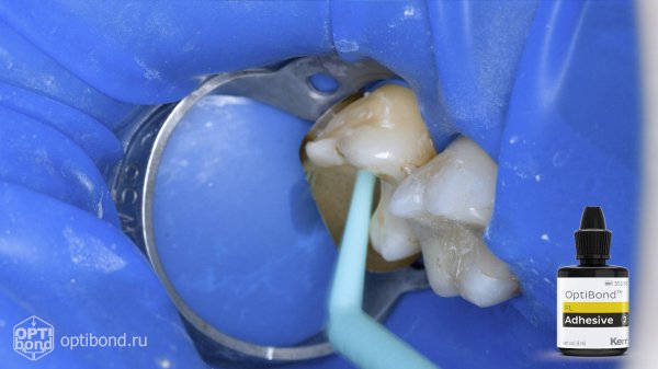 #Optibond application to occlusial surfaces of tooth 17 #purplerubberdam #rubberdamology