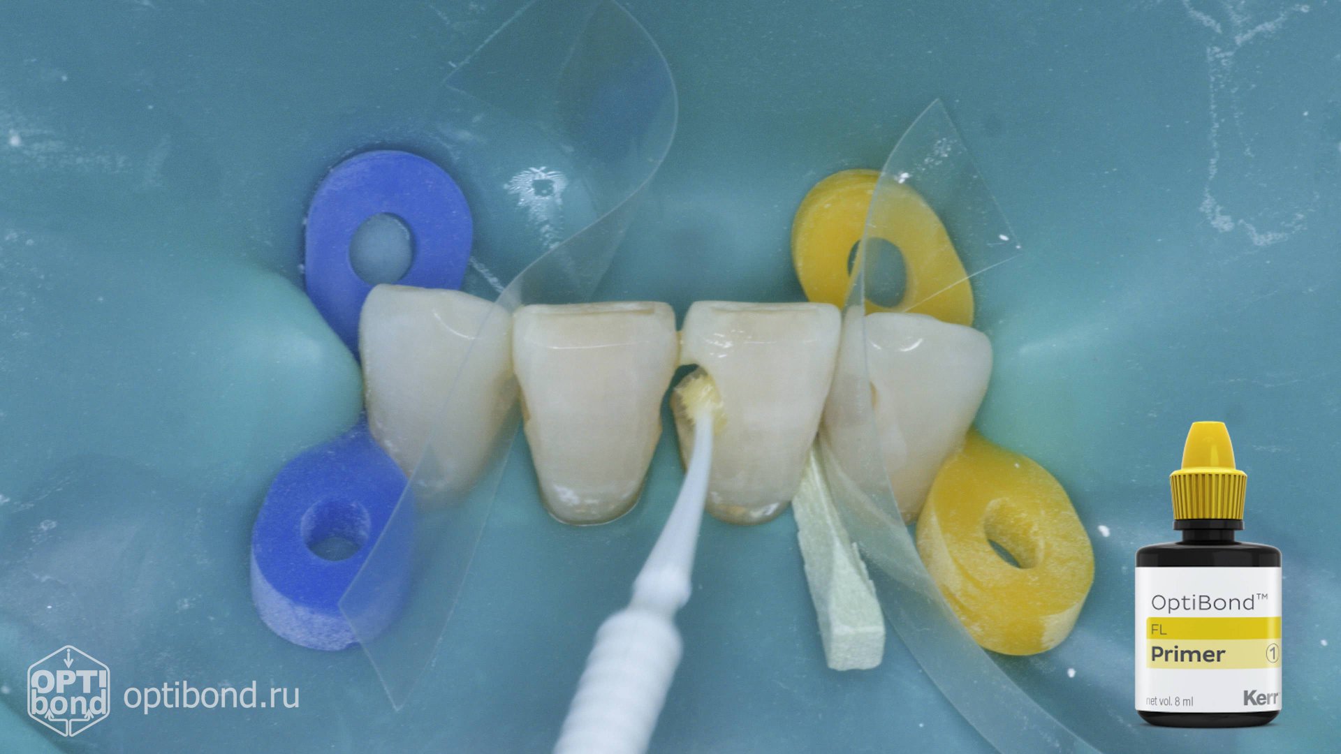 #Optibond application to contact surfaces of tooth 32, 31, 41, 42 #rubberdamology смотреть онлайн