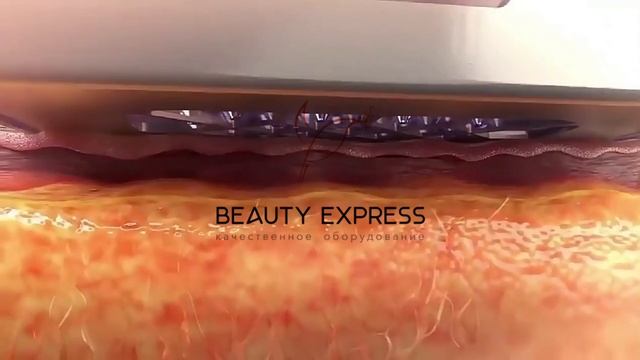 Аппарат фракционного микроигольчатого RF лифтинга MR 8 PRO (3 манипулы) на стойке и без стойки смотреть онлайн