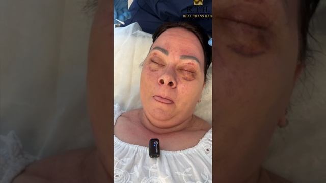 Неделя после блефаропластики: время снимать швы! смотреть онлайн