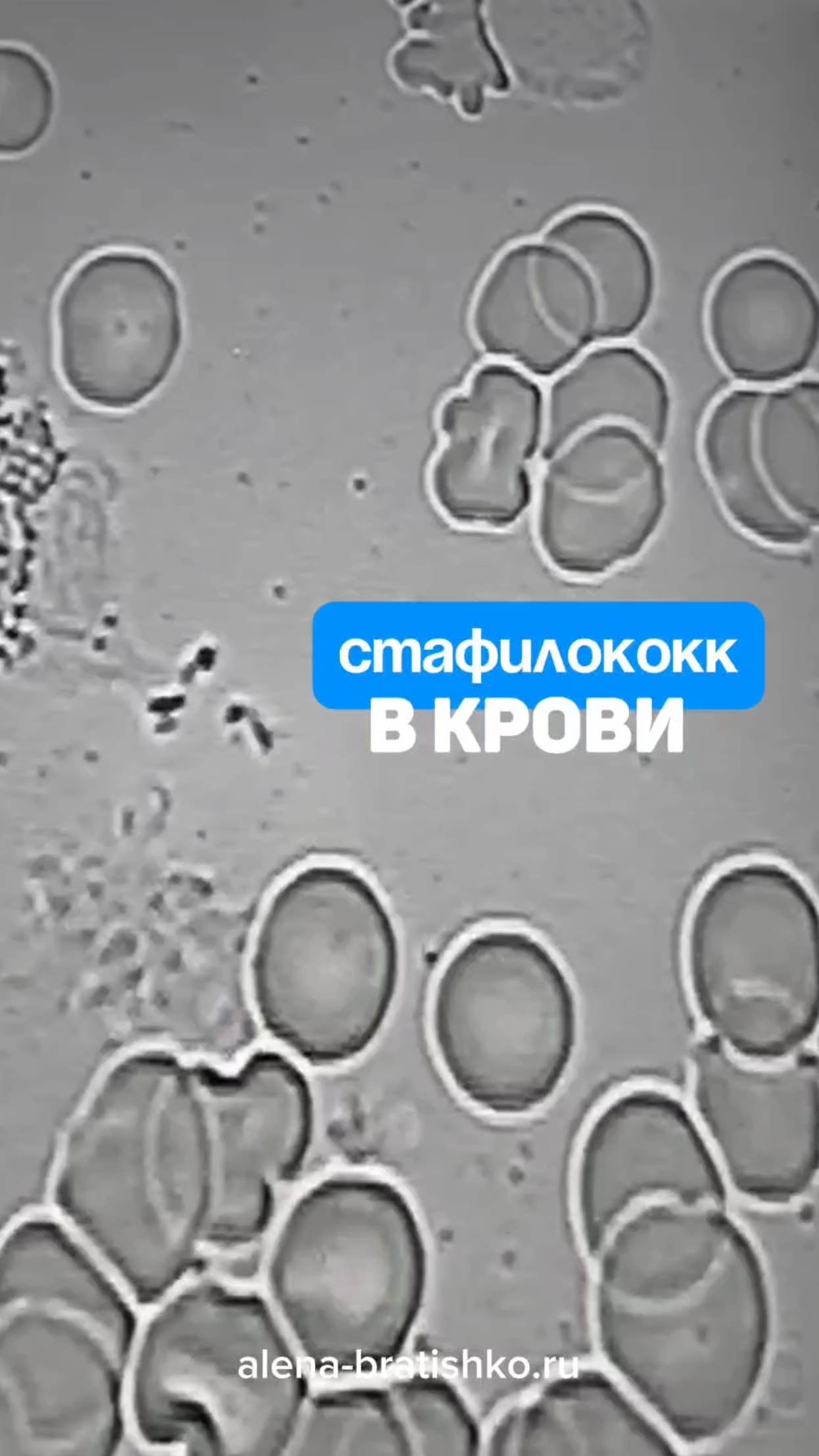 Стафилококк в крови под микроскопом. Семейный доктор Алена Братишко смотреть онлайн