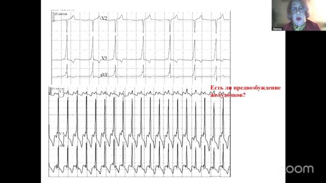 СИНДРОМ ВОЛЬФА-ПАРКИНСОНА-УАЙТА (WPW) У ДЕТЕЙ. ТРУДНОСТИ ДИАГНОСТИКИ И ВЕДЕНИЯ