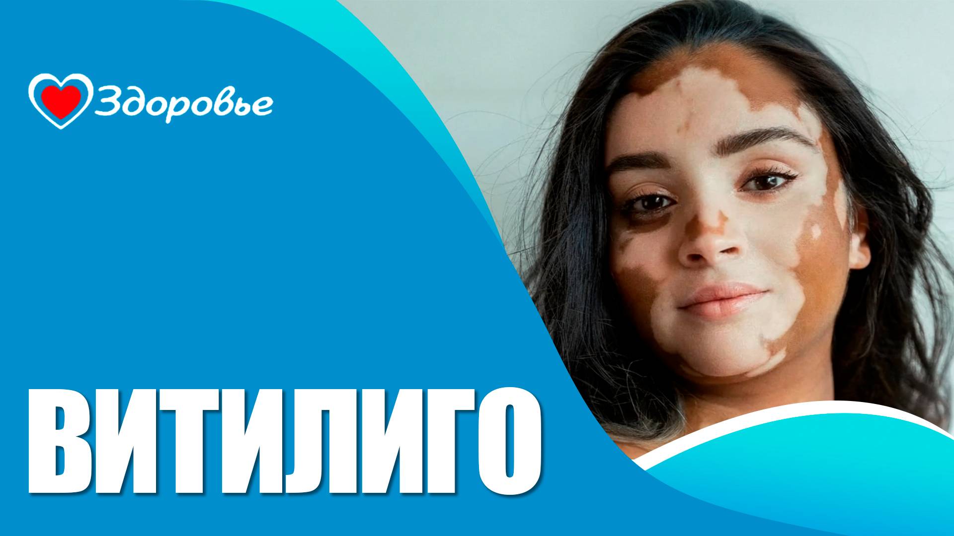 Здоровье. Витилиго