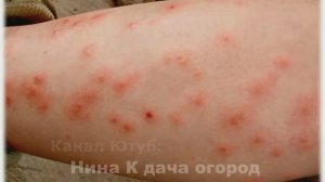 Мошкара: КАК БОРОТЬСЯ С МОШКОЙ И КОМАРАМИ на огороде. Как снять припухлость и кожный зуд при укусе