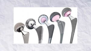 Не прижился протез тазобедренного сустава. Ревизионное эндопротезирование тазобедренного сустава.