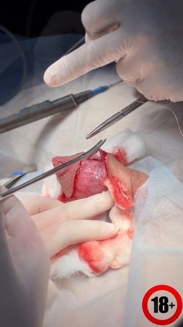 Эстетическое обрезание по авторской методике Доценко