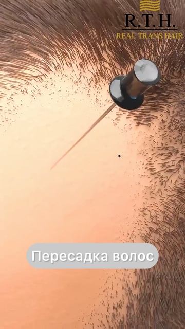 Чего вы еще не знаете о пересадке волос? смотреть онлайн