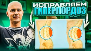 Как исправить гиперлордоз?