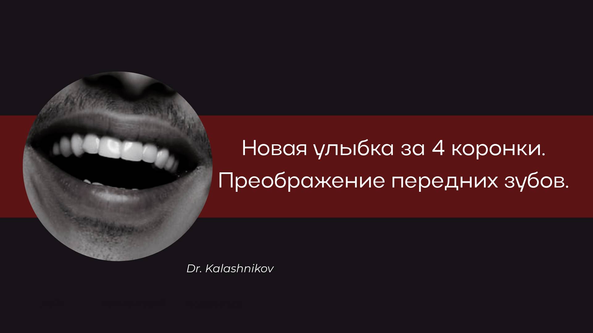 НОВАЯ УЛЫБКА ЗА 4 КОРОНКИ. ПРЕОБРАЖЕНИЕ ПЕРЕДНИХ ЗУБОВ.