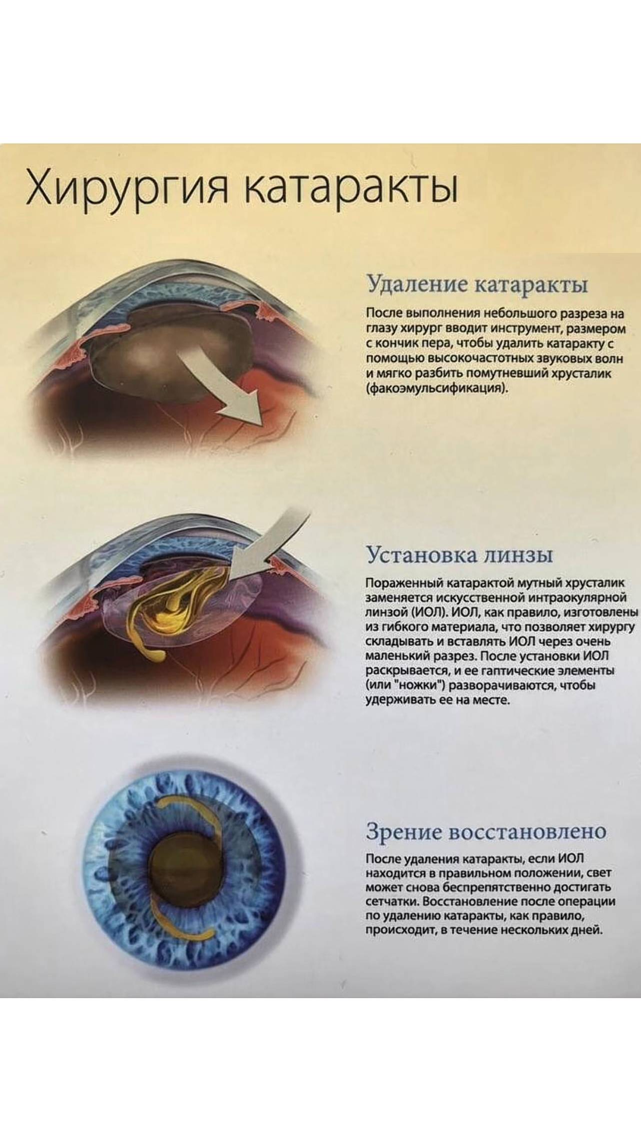 👁 Катаракта — не повод откладывать зрение на потом смотреть онлайн
