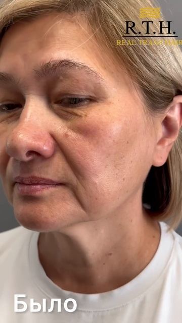 Месяц после блефаропластики смотреть онлайн