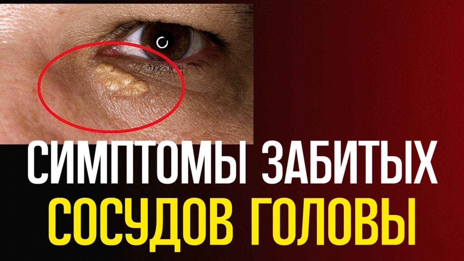 10 ПРИЗНАКОВ ЗАБИТЫХ СОСУДОВ ГОЛОВЫ смотреть онлайн