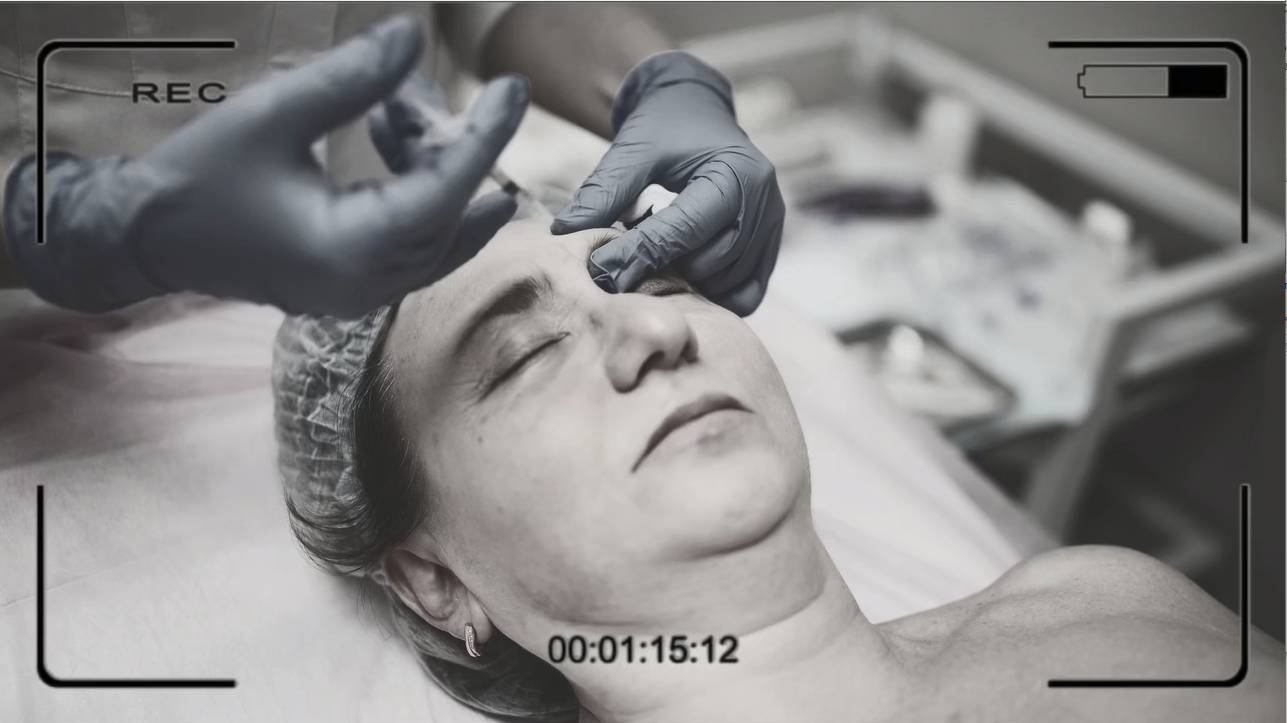 Ботулинотерапия и векторный лифтинг: реальный результат! #ПодтяжкаЛица #БьютиПроцедуры