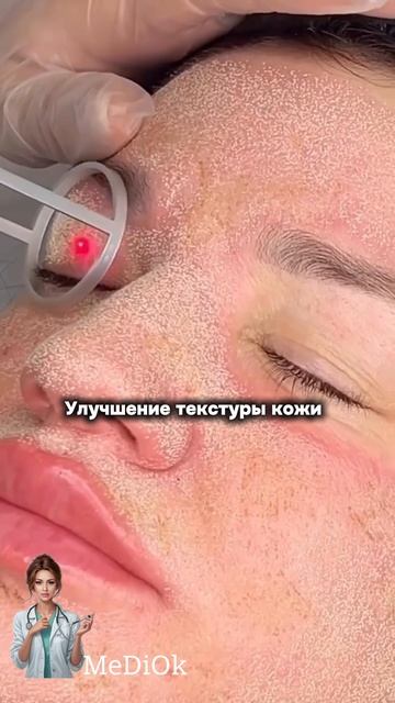 Лазерная шлифовка лица