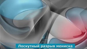 Артроскопия коленного сустава на примере разрыва мениска - инфографика операции на колене