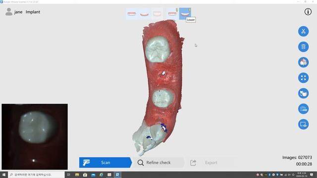 Интраоральный сканер Runyes IoS-11 – пример 3D-сканирования зубного ряда №4 смотреть онлайн