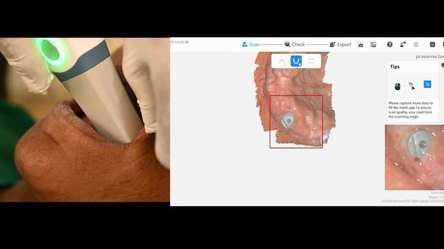 Интраоральный сканер Runyes IoS-11 – пример 3D-сканирования зубного ряда №1 смотреть онлайн