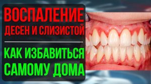 Как быстро снять воспаление десен и слизистой оболочки дома