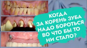 Почему и когда корни зубов стоит сохранять?