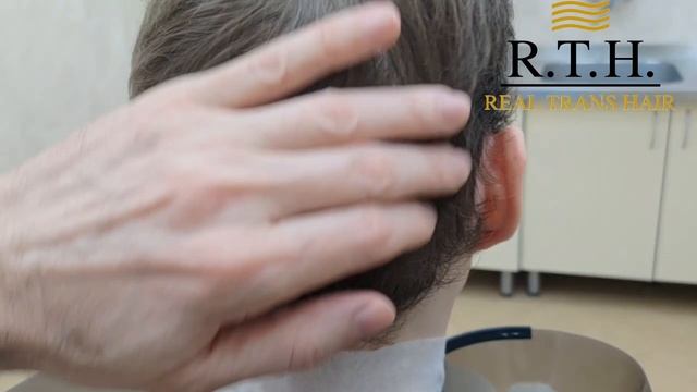 1,5 года спустя: смотрим на донорскую зону после пересадки волос! смотреть онлайн