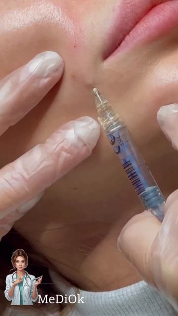 КОРРЕКЦИЯ НОСОГУБНОЙ СКЛАДКИ