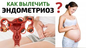 Как вылечить все ЖЕНСКИЕ ЗАБОЛЕВАНИЯ? Эндометриоз! МИОМА МАТКИ! Бесплодие