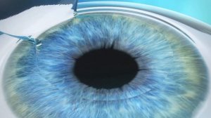Femto Super LASIK - визуализация процесса коррекции зрения